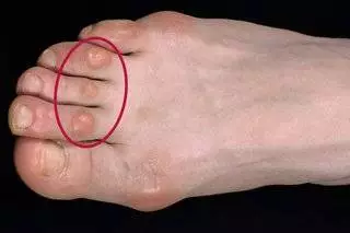 Foot Corns and Calluses