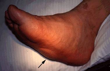 Charcot's Foot