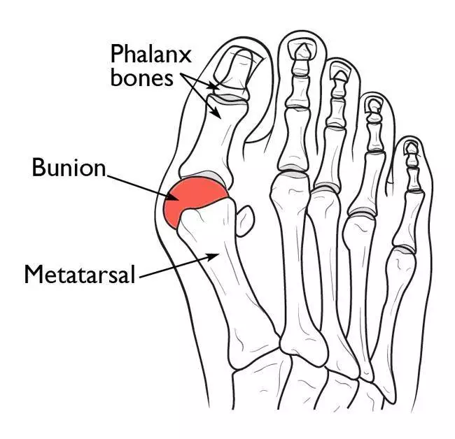 Nonsurgical Solutions For Bunions