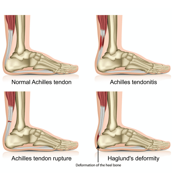 Symptoms of Achilles Tendonitis