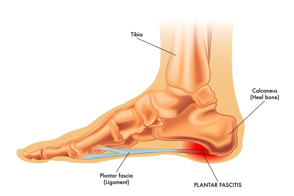 Plantar Fasciitis Stretches in Bed
