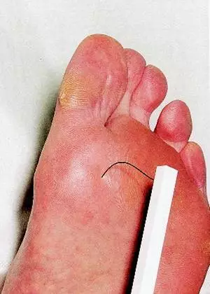Five Steps to Prevent Diabetic Foot Problems