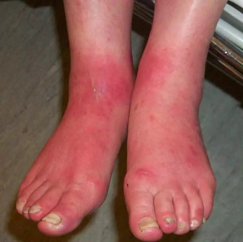 What is Grierson Gopalan Syndrome?