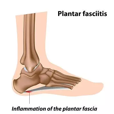 What Happens If Plantar Fasciitis Is Not Treated?