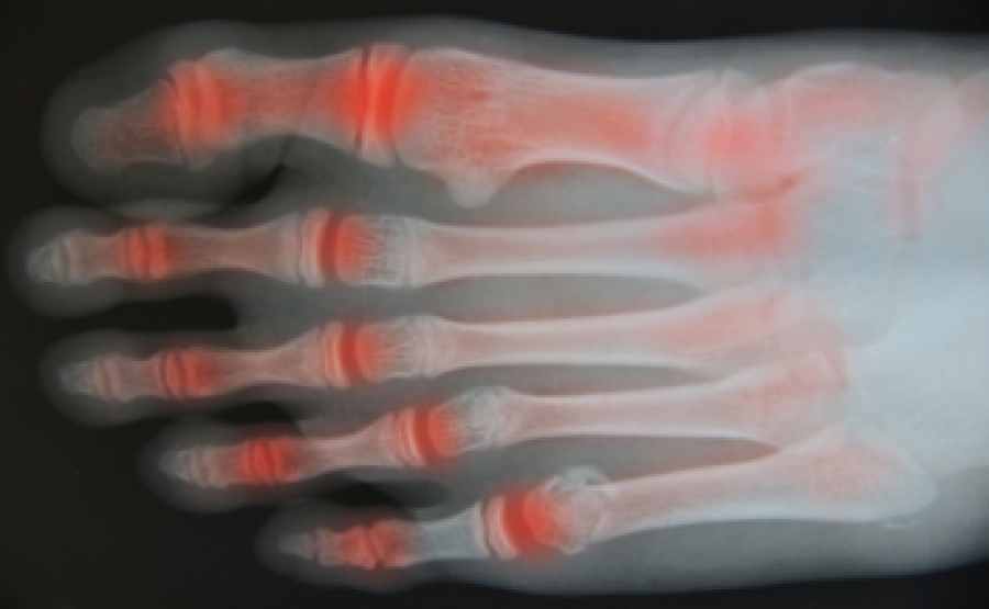 What Are the Signs of Arthritis in Your Feet?